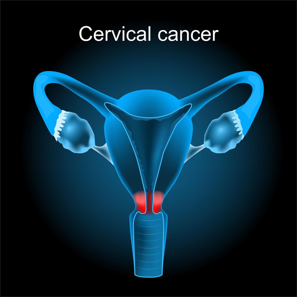 Cáncer de cuello uterino y virus papiloma humano: la importancia de individualizar la revisión ginecológica.