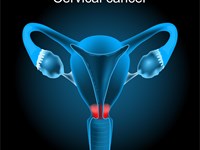 Cáncer de cuello uterino y virus papiloma humano: la importancia de individualizar la revisión ginecológica.