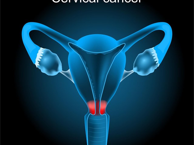 Cáncer de cuello uterino y virus papiloma humano: la importancia de individualizar la revisión ginecológica.
