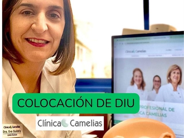 Colocación del DIU: qué es, cómo se coloca y qué control debes hacer. 