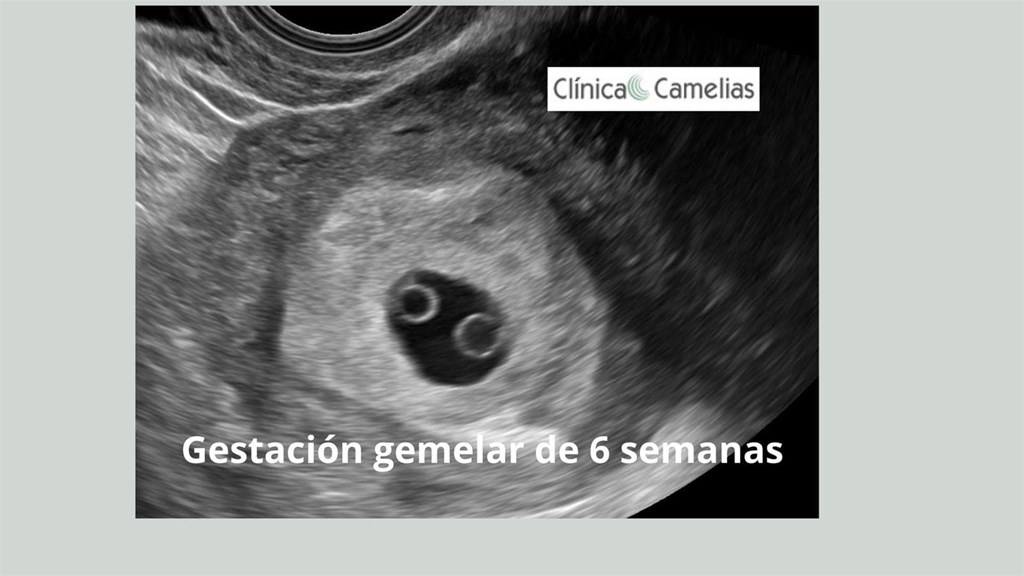 Embarazo gemelar: por qué está aumentando y su importancia. 