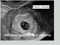 Embarazo gemelar: por qué está aumentando y su importancia. 