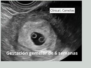 Embarazo gemelar: por qué está aumentando y su importancia. 