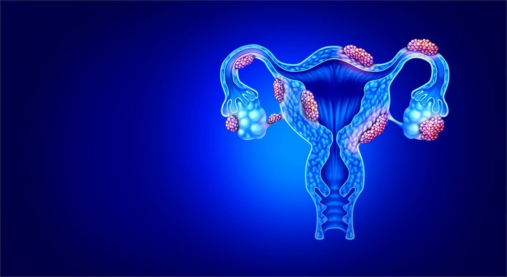 Endometriosis, la enfermedad que sufren 170 millones de mujeres
