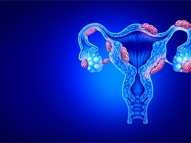 Endometriosis, la enfermedad que sufren 170 millones de mujeres