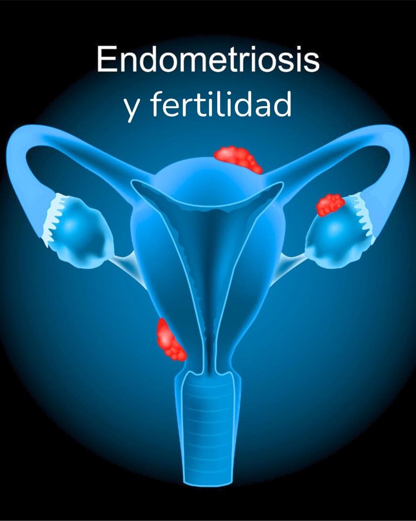  Endometriosis y preservación de fertilidad: la importancia de conocer tus opciones a tiempo.