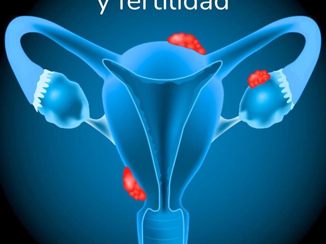  Endometriosis y preservación de fertilidad: la importancia de conocer tus opciones a tiempo.