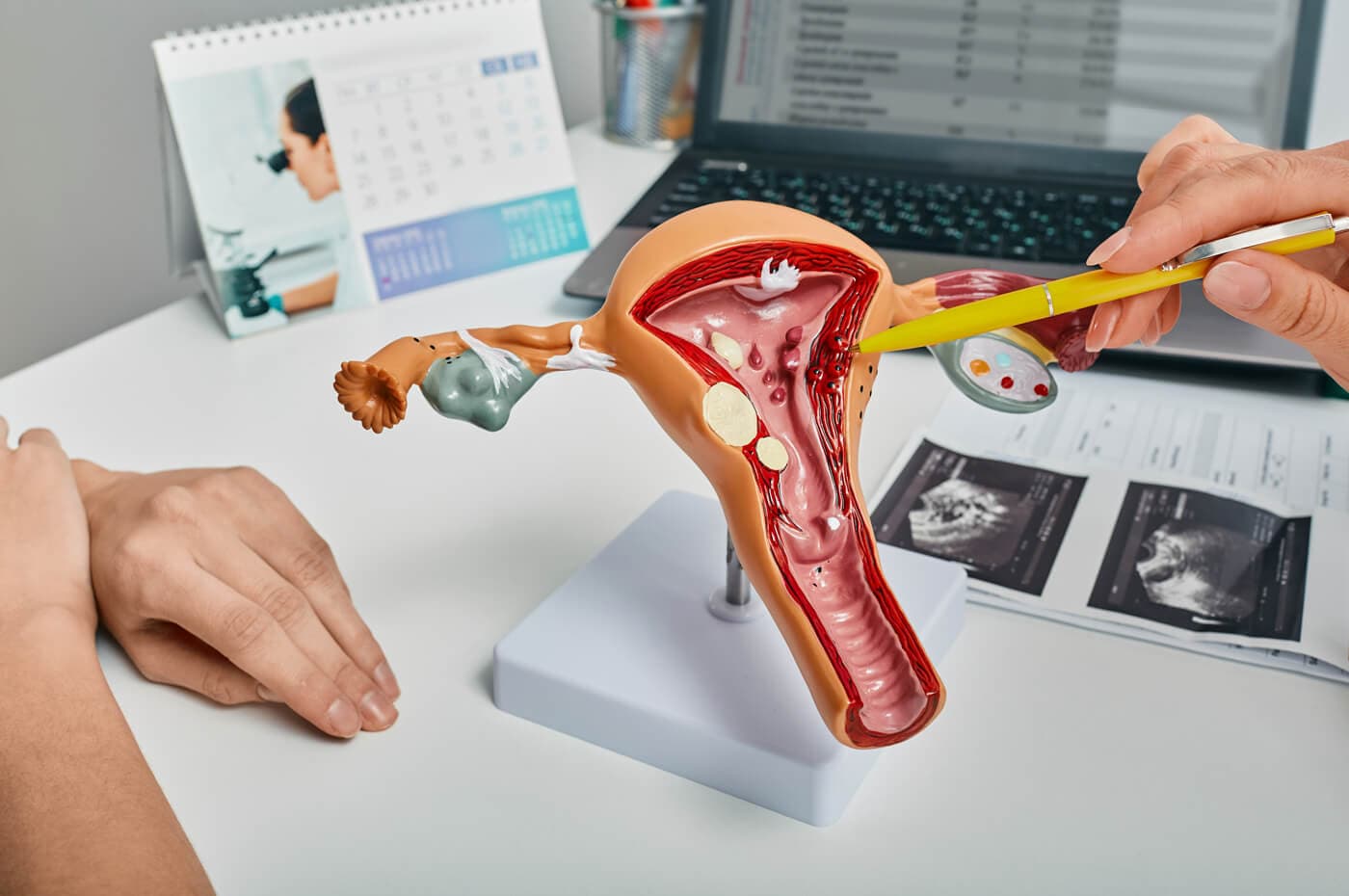 Tratamiento de pólipos endometriales en Vigo