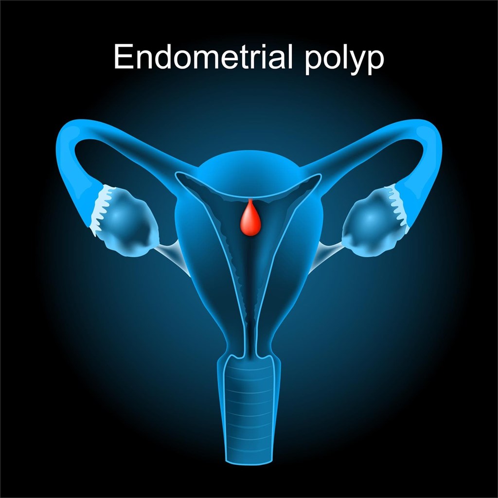 ¿ Que son los pólipos endometriales y como se tratan?