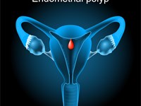 ¿ Que son los pólipos endometriales y como se tratan?