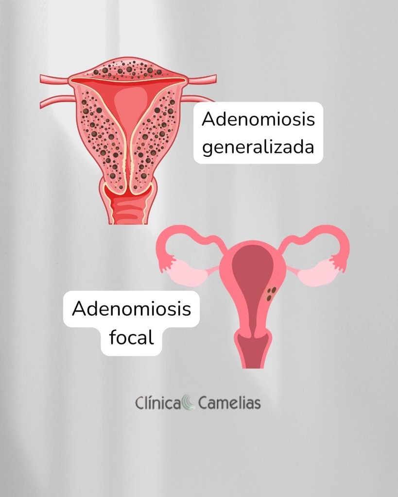 Reglas abundantes y adenomiosis uterina: diagnóstico y soluciones en Clínica Camelias Vigo.