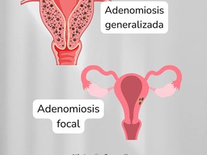Reglas abundantes y adenomiosis uterina: diagnóstico y soluciones en Clínica Camelias Vigo.