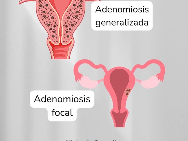 Reglas abundantes y adenomiosis uterina: diagnóstico y soluciones en Clínica Camelias Vigo.