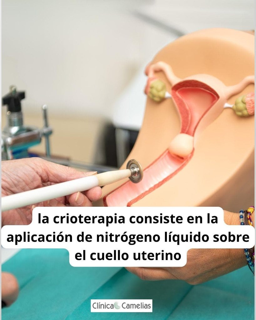 Tratamiento de la displasia cervical leve CIN 1 con crioterapia.