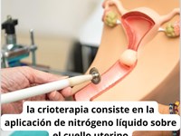 Tratamiento de la displasia cervical leve CIN 1 con crioterapia.