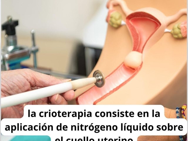 Tratamiento de la displasia cervical leve CIN 1 con crioterapia.